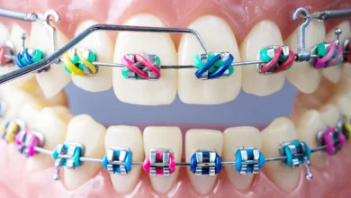 سعر تقويم الاسنان في مصر