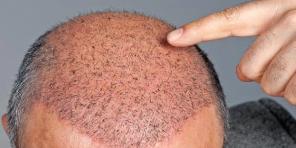 زراعة الشعر في جدة