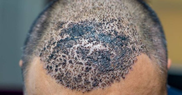 زراعة الشعر في جدة