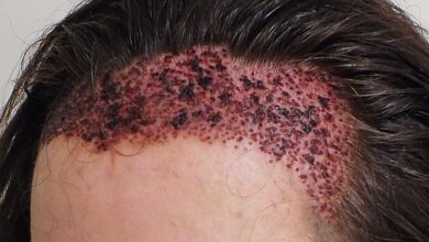 زراعة الشعر في جدة