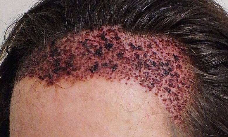 زراعة الشعر في جدة