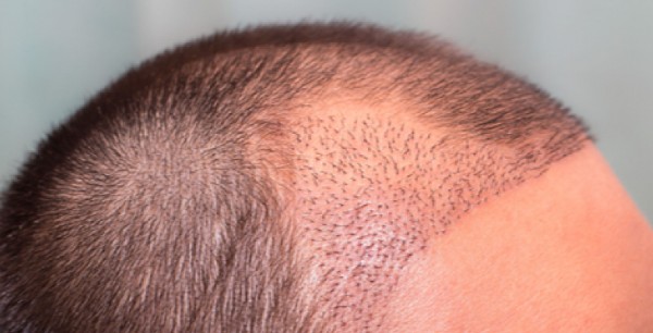 زراعة الشعر في جدة