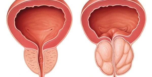 التهاب البروستاتا المزمن