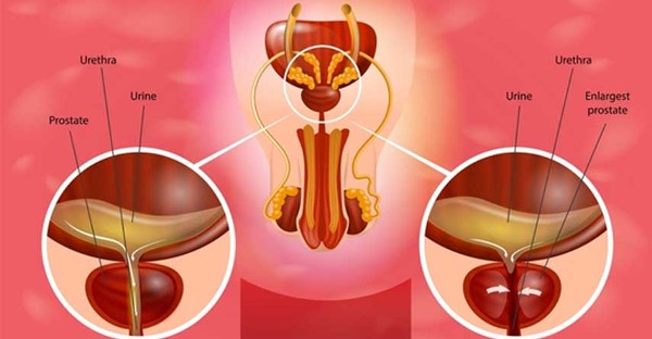 التهاب البروستاتا المزمن