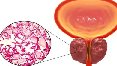 التهاب البروستاتا المزمن