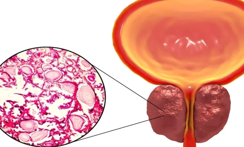 التهاب البروستاتا المزمن