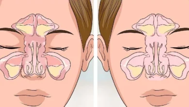 علاج انسداد الأنف