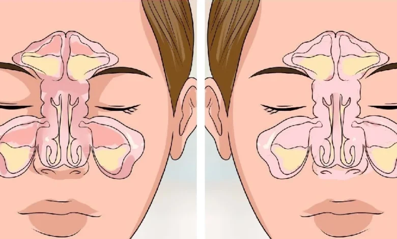 علاج انسداد الأنف