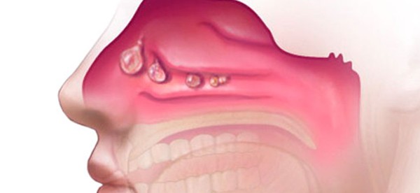 علاج انسداد الأنف