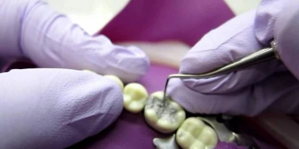 عجينة حشو الأسنان في المنزل