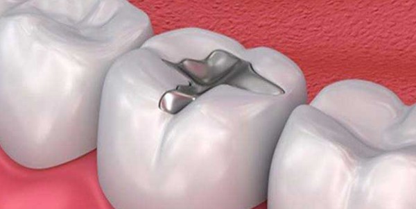 عجينة حشو الأسنان في المنزل