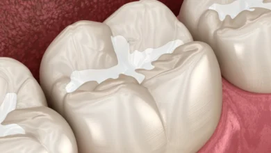 عجينة حشو الأسنان في المنزل