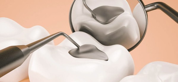 عجينة حشو الأسنان في المنزل