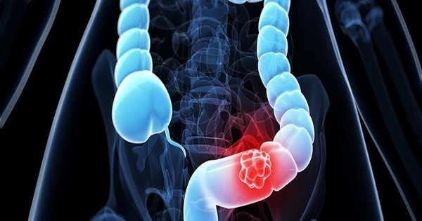 علاج القولون العصبى