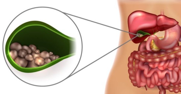 علاج حصى المرارة