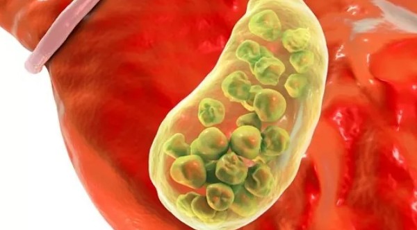 علاج حصى المرارة