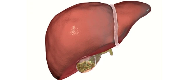 علاج حصى المرارة