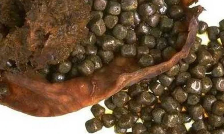 علاج حصى المرارة