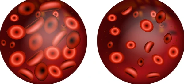 علاج فقر الدم