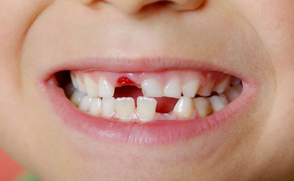 تفسير حلم وقوع الأسنان