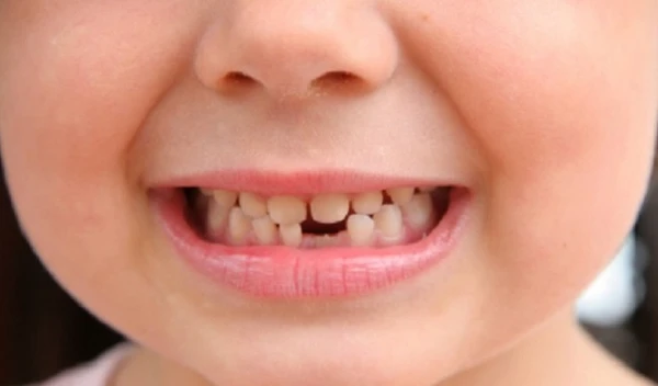 تفسير حلم وقوع الأسنان