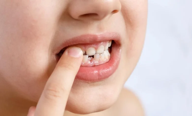 تفسير حلم وقوع الأسنان