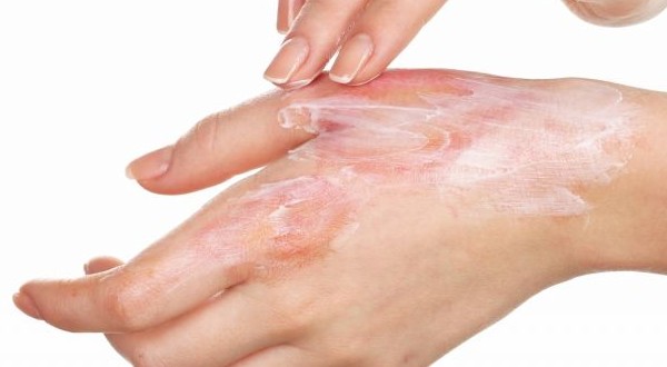 افضل كريم للحروق