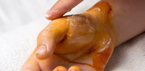 افضل كريم للحروق