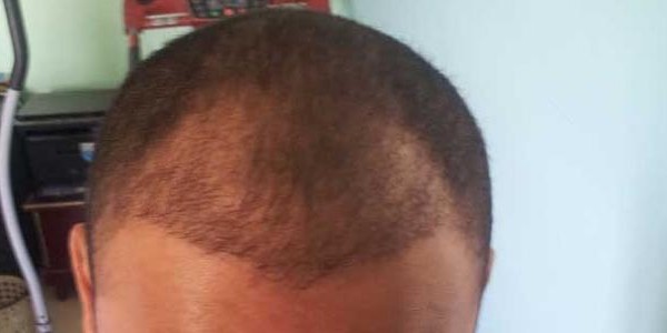 أفضل امبولات للشعر الخفيف