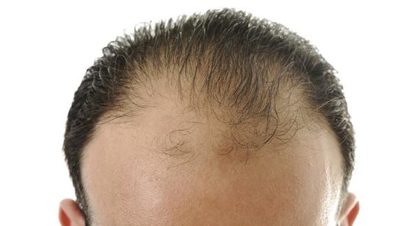 أفضل امبولات للشعر الخفيف