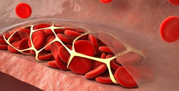 تخثر دم الجنين