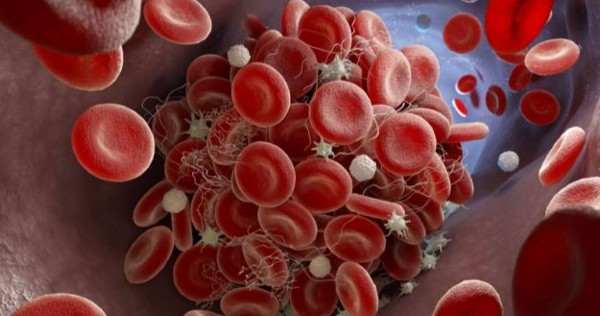 تخثر دم الجنين