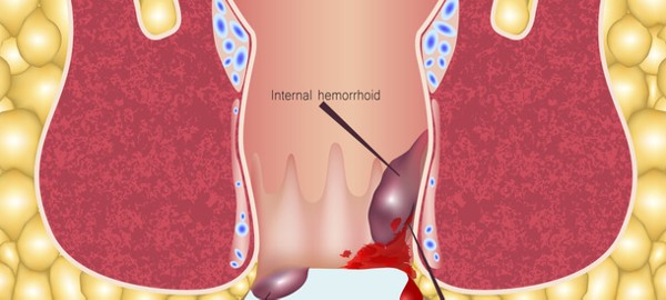 افضل طرق علاج البواسير