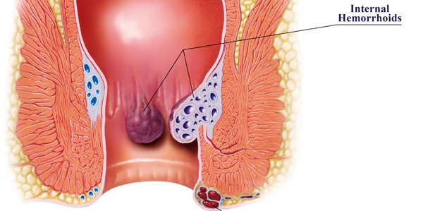 افضل طرق علاج البواسير