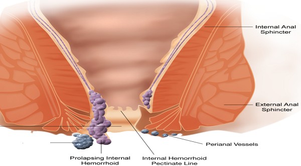 افضل طرق علاج البواسير